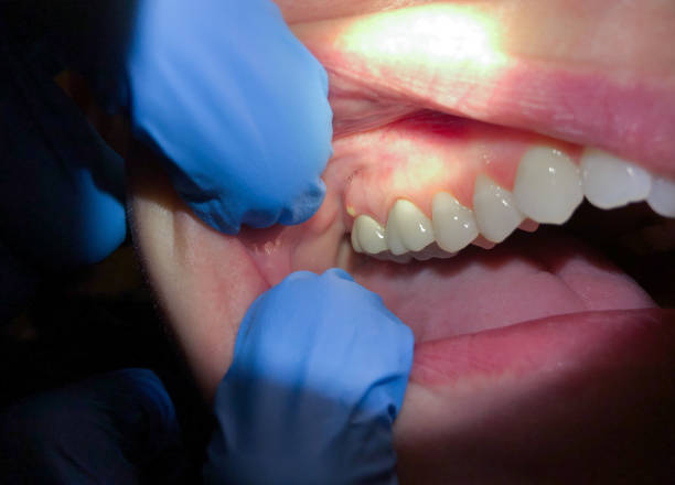 Best Emergency Dental Care for Broken or Chipped Teeth in Oill, NE